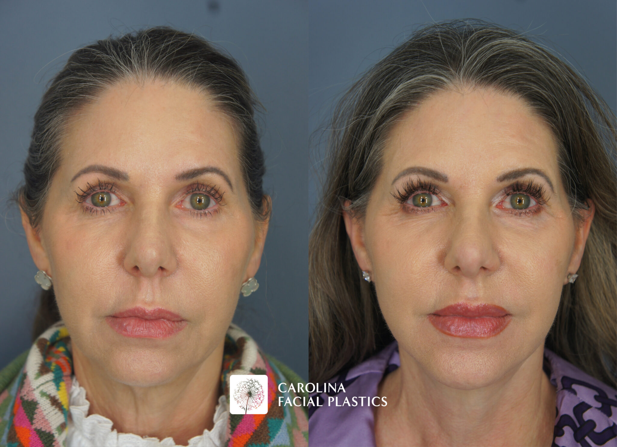 Lower Face, Neck Lift with Platysmaplasty & Fat Grafting
