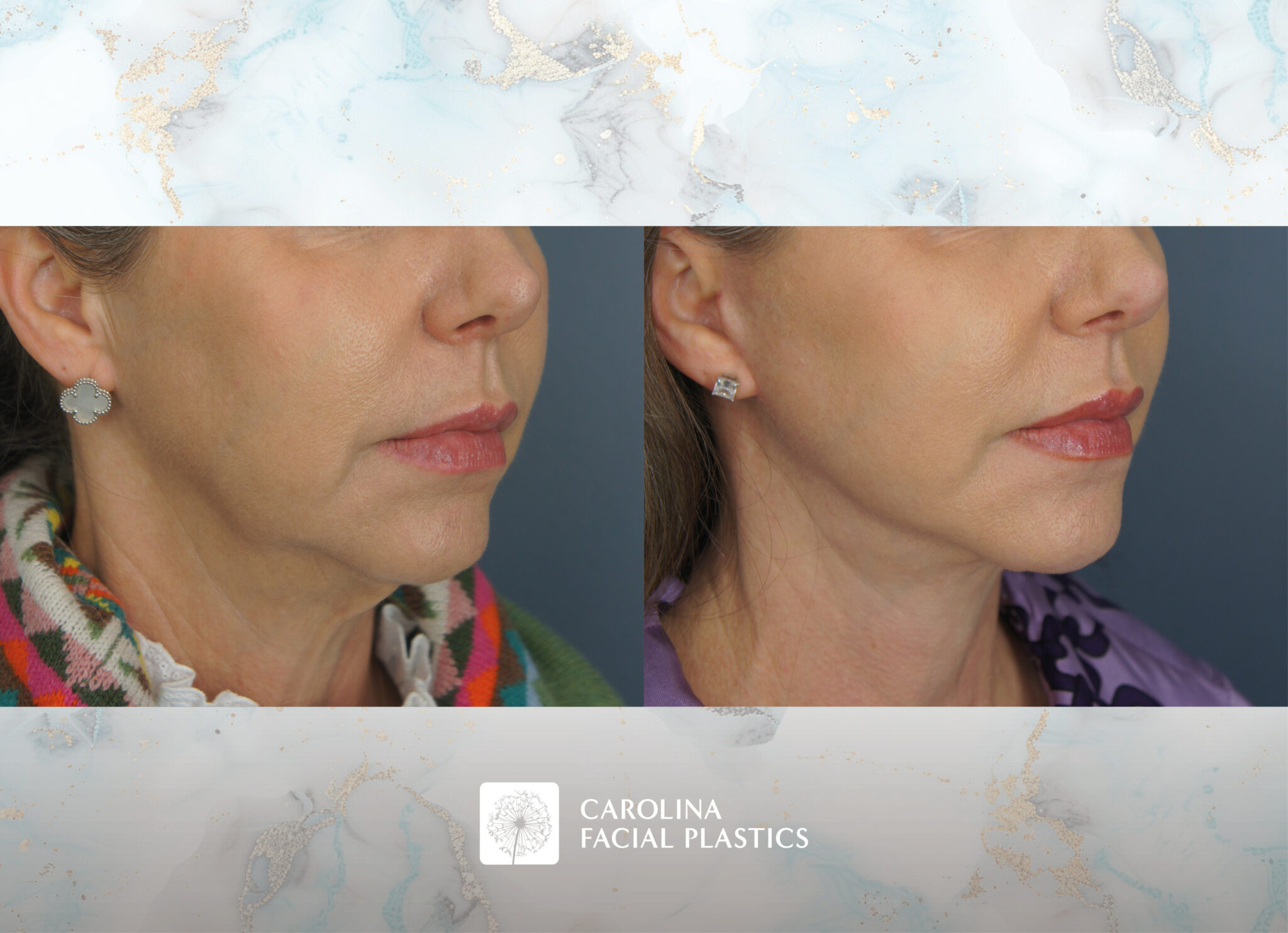 Lower Face, Neck Lift with Platysmaplasty & Fat Grafting