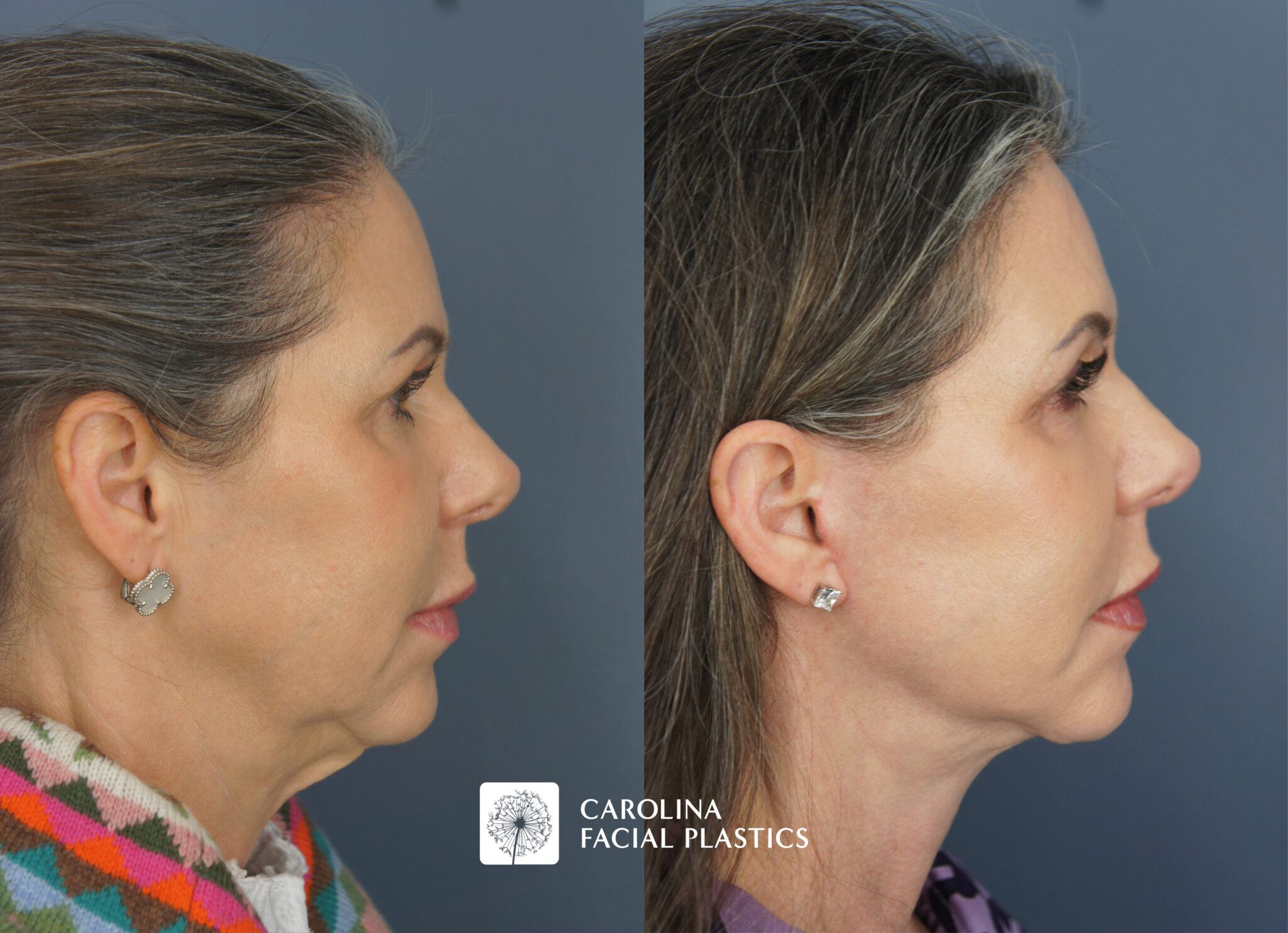 Lower Face, Neck Lift with Platysmaplasty & Fat Grafting