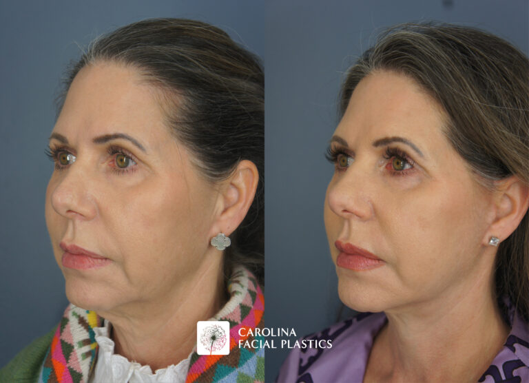 Lower Face, Neck Lift with Platysmaplasty & Fat Grafting