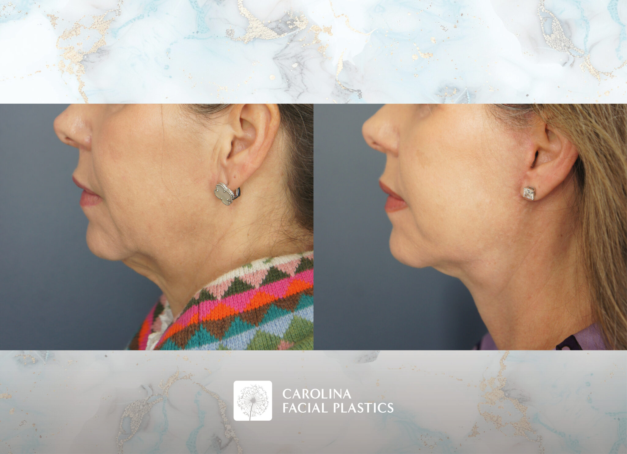 Lower Face, Neck Lift with Platysmaplasty & Fat Grafting