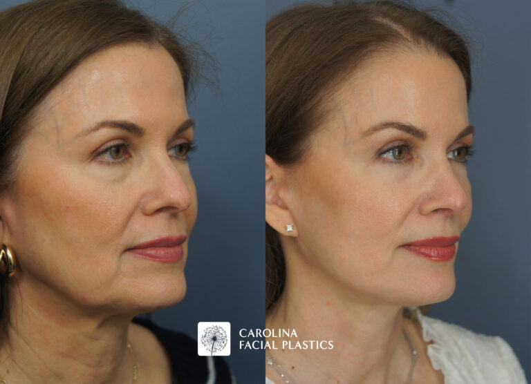 Mini Facelift & Rhinoplasty