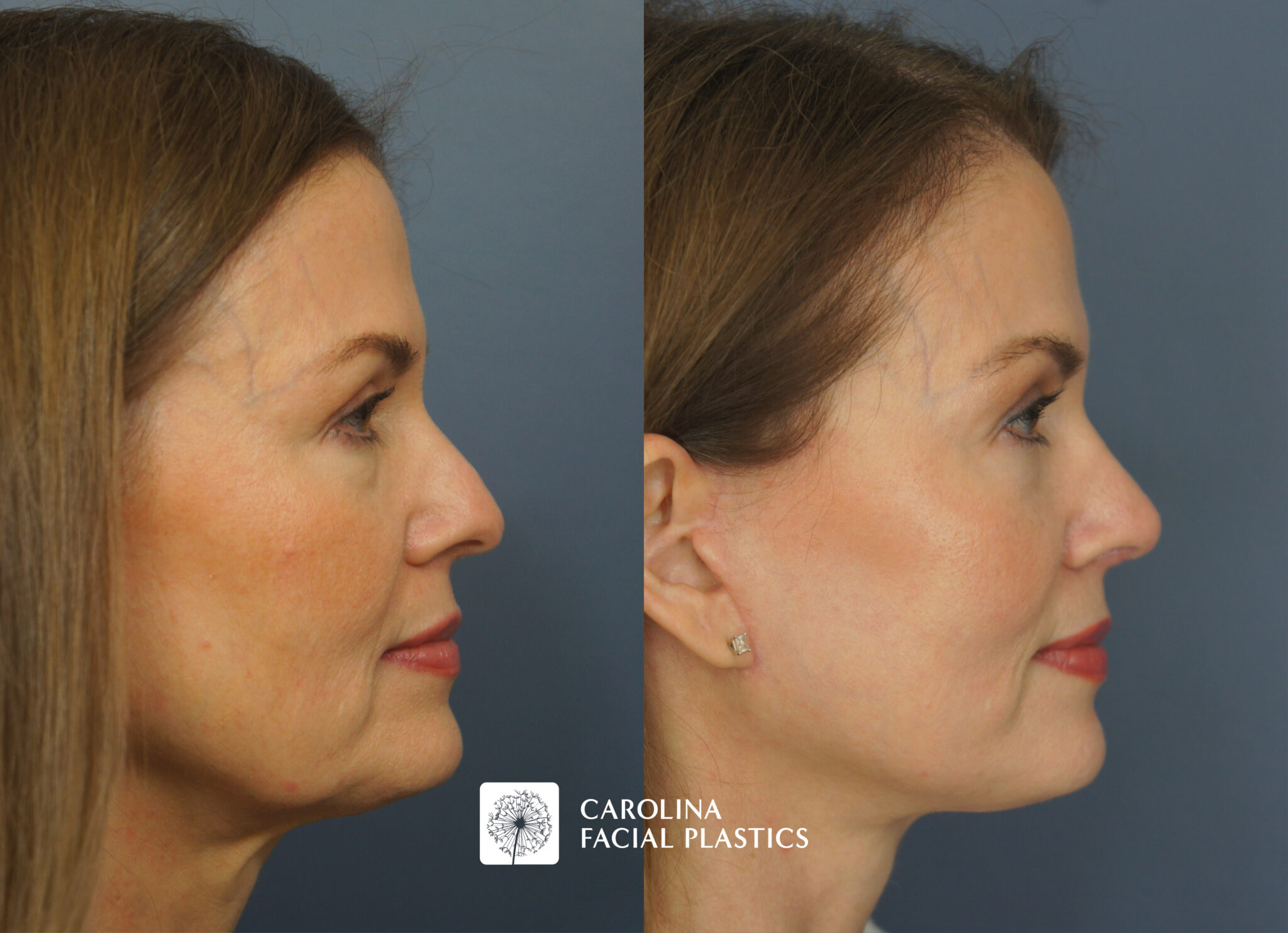 Mini Facelift & Rhinoplasty