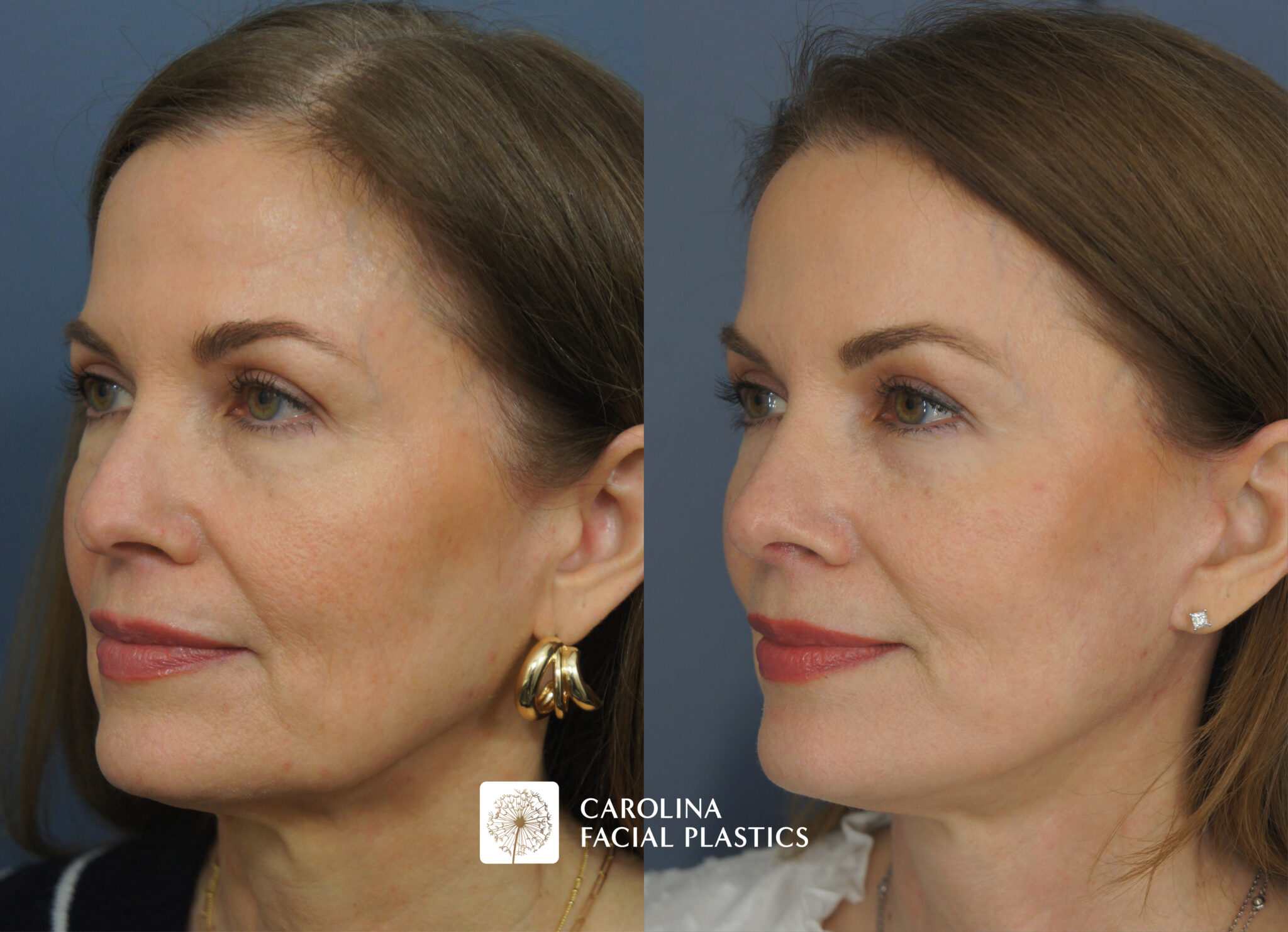 Mini Facelift & Rhinoplasty