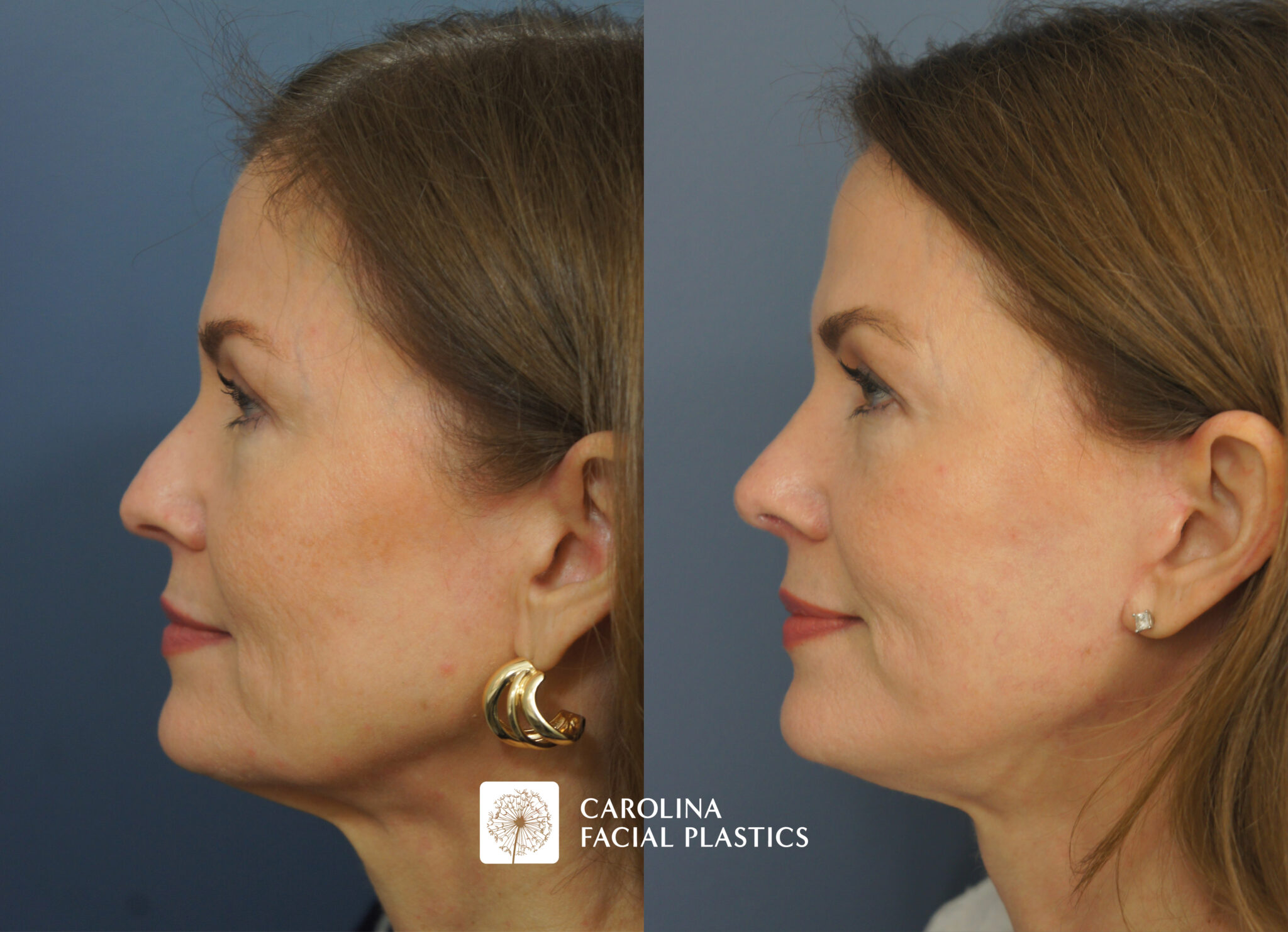 Mini Facelift & Rhinoplasty