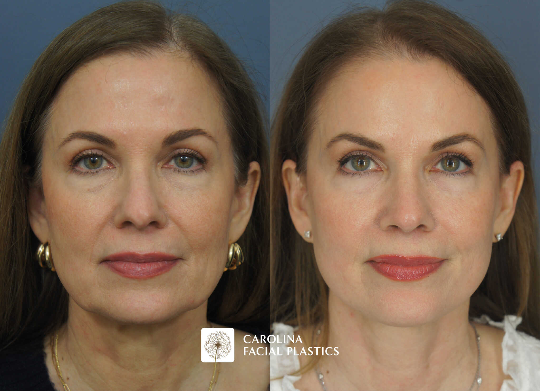 Mini Facelift & Rhinoplasty