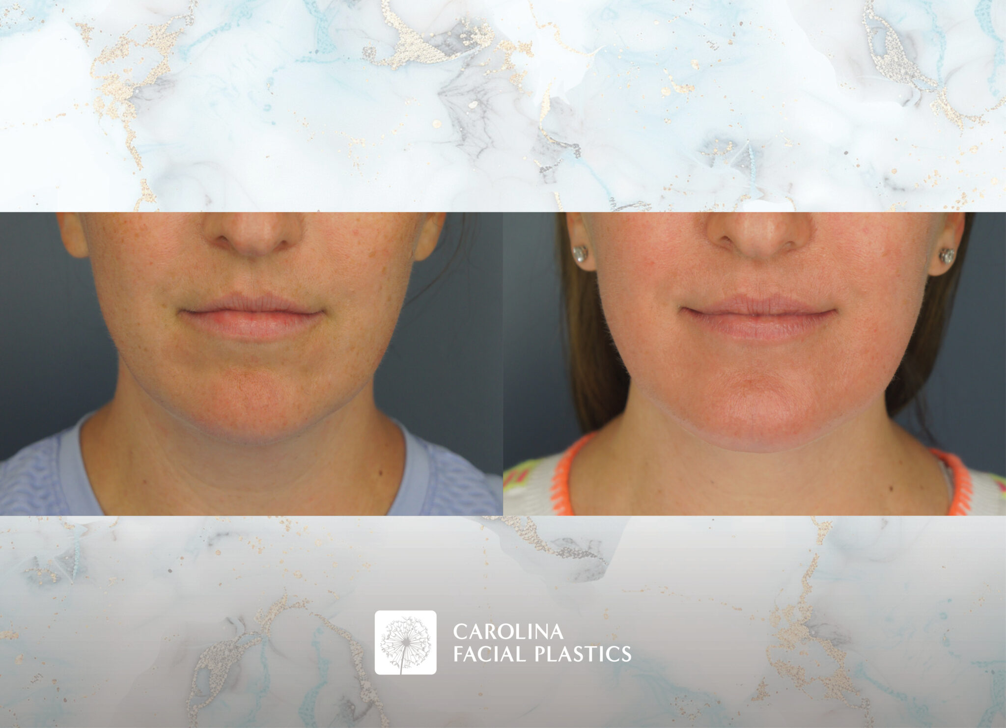 Chin Implant & Neck Liposuction