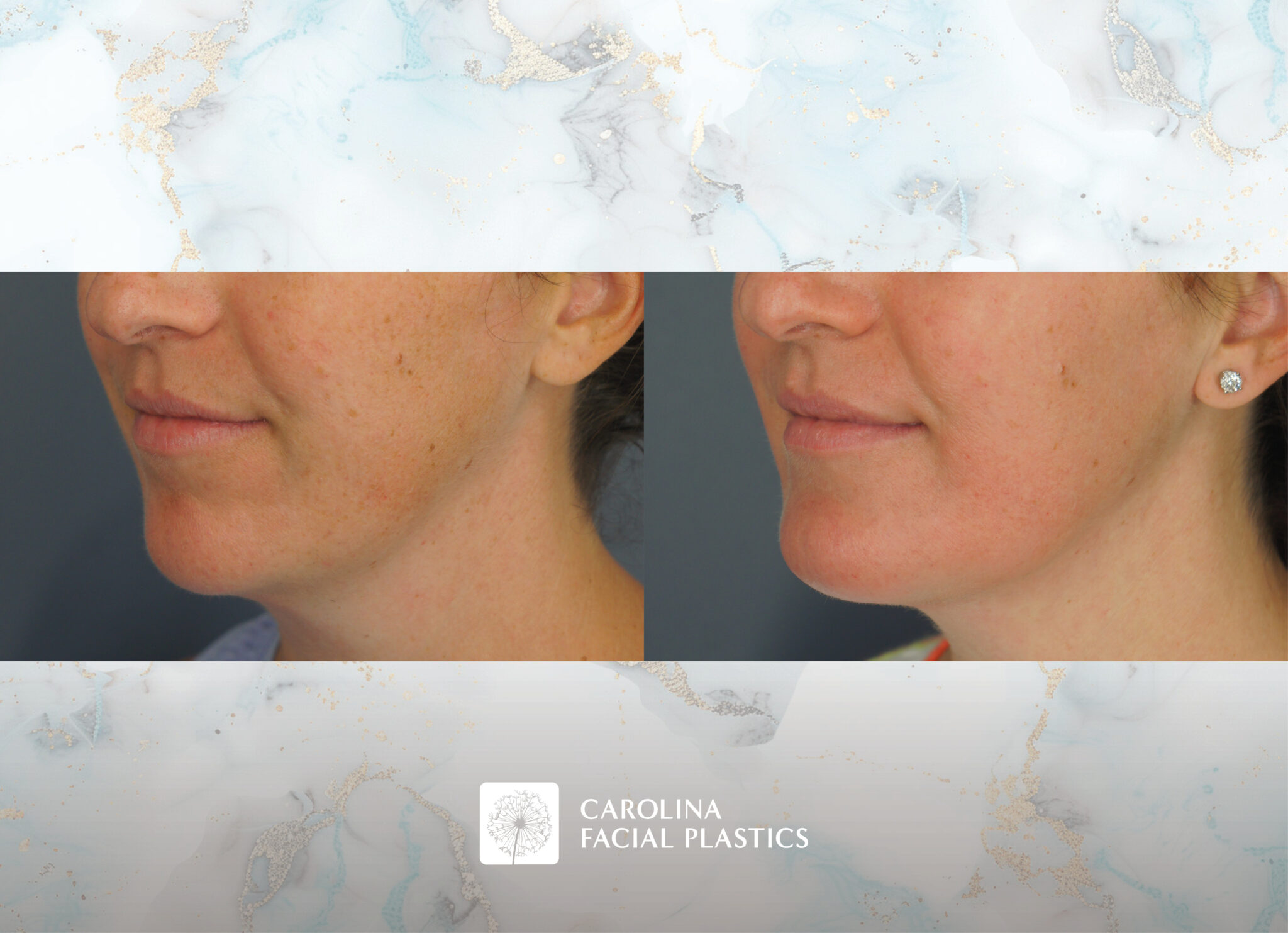 Chin Implant & Neck Liposuction