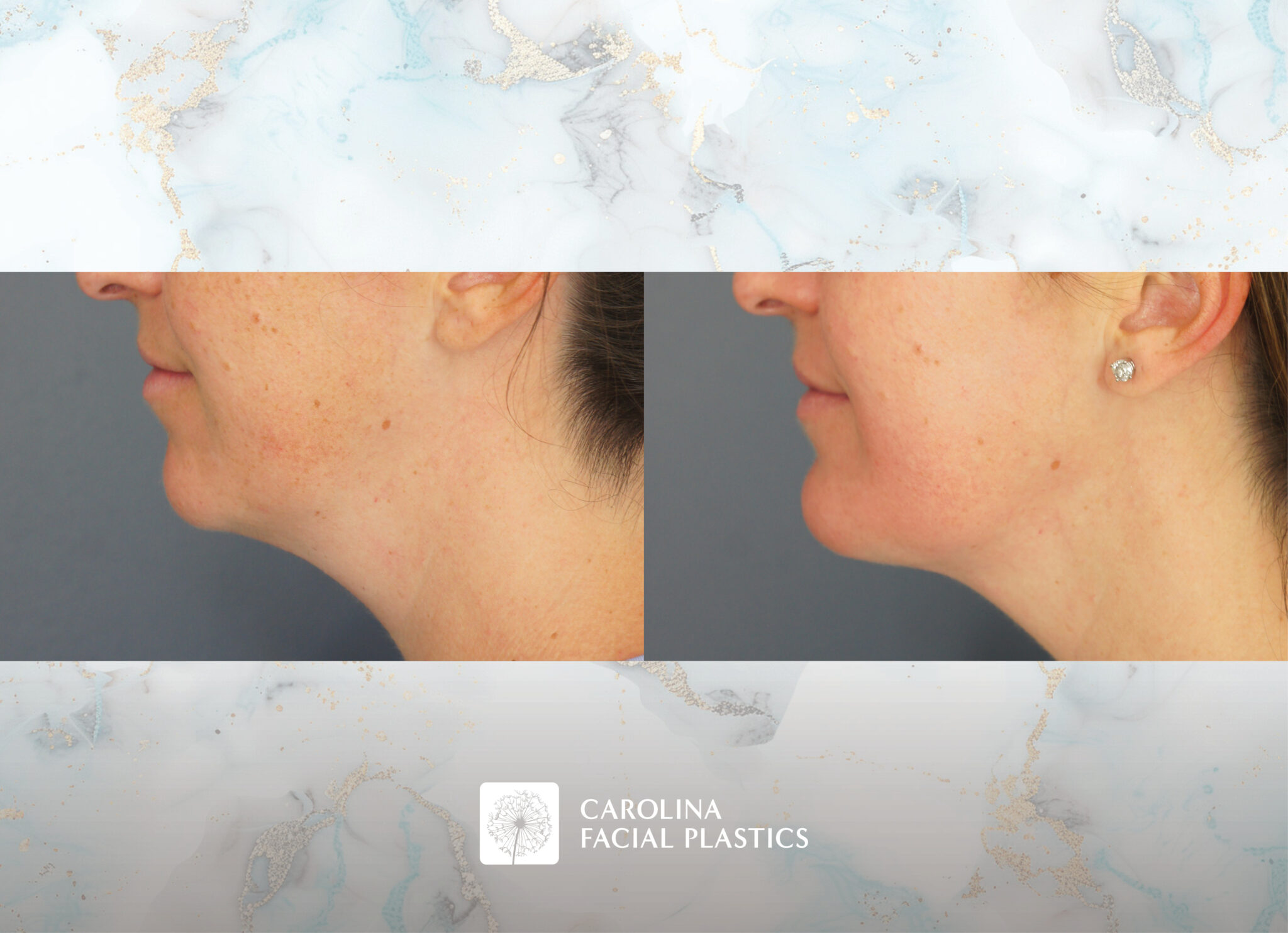 Chin Implant & Neck Liposuction