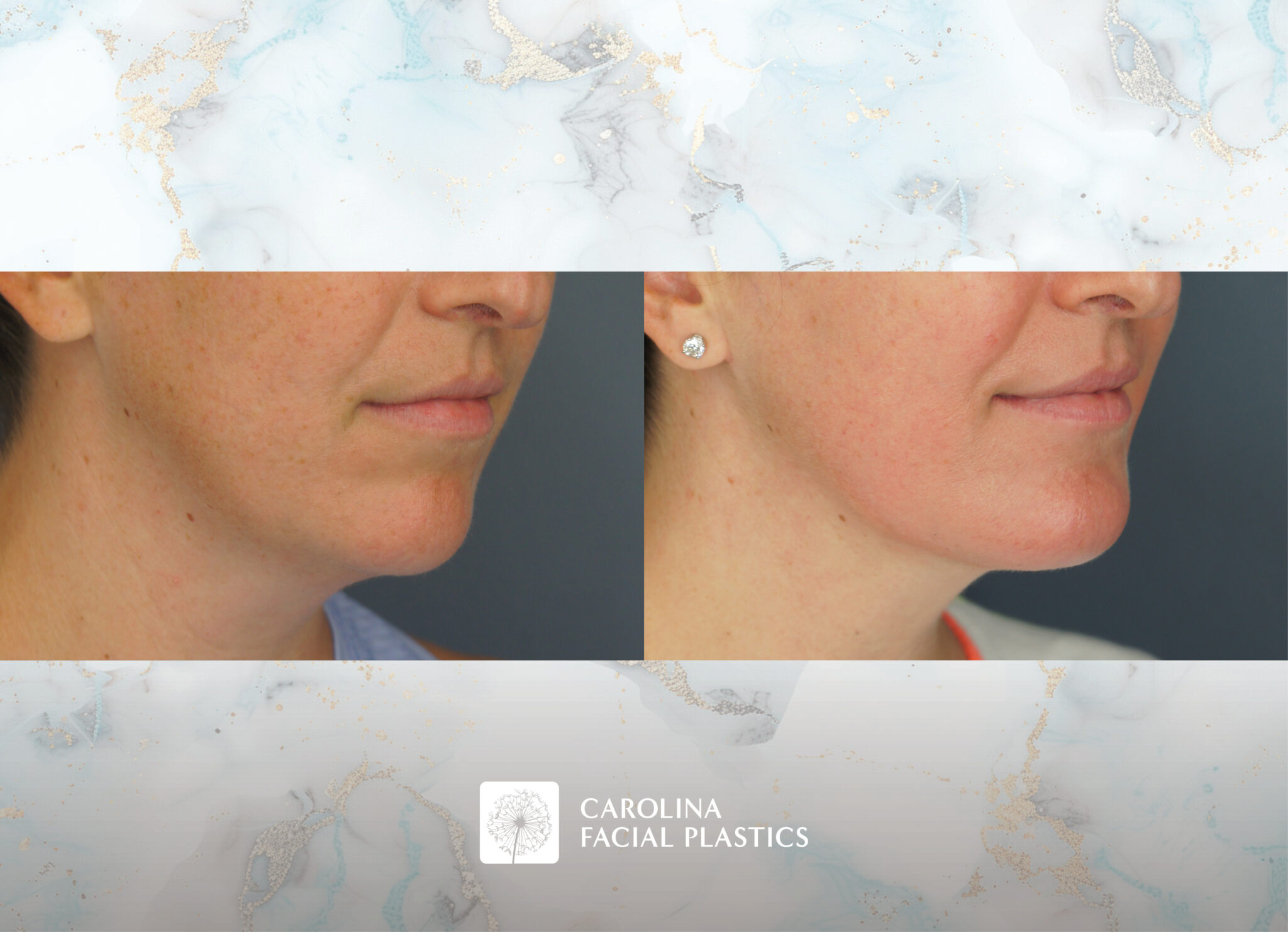 Chin Implant & Neck Liposuction