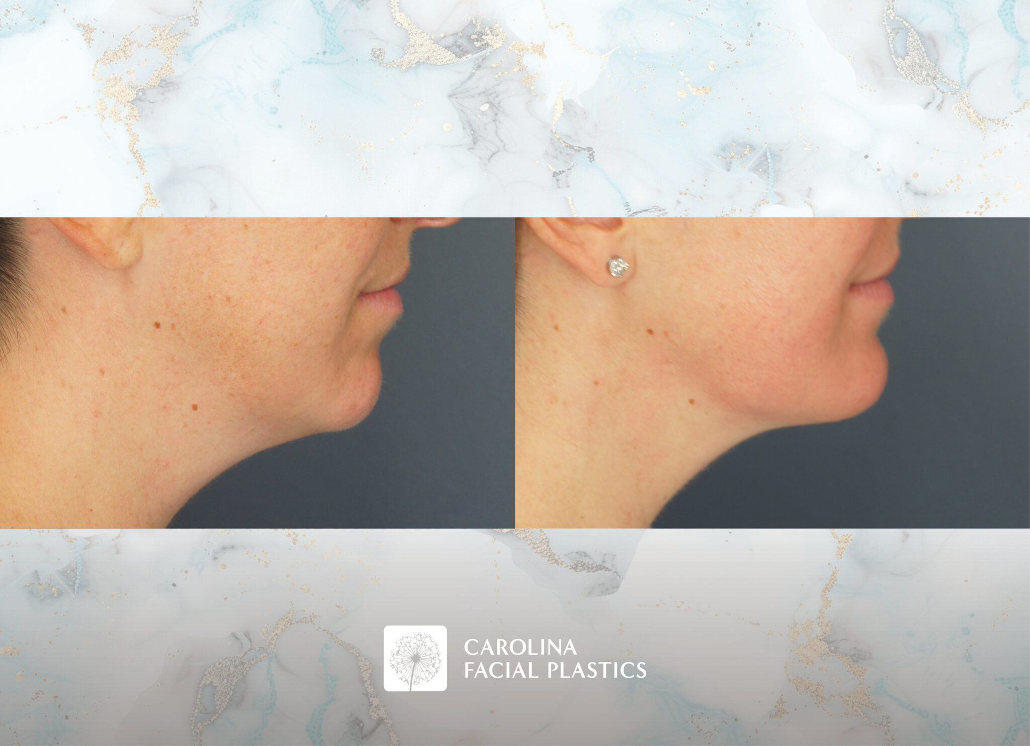 Chin Implant & Neck Liposuction