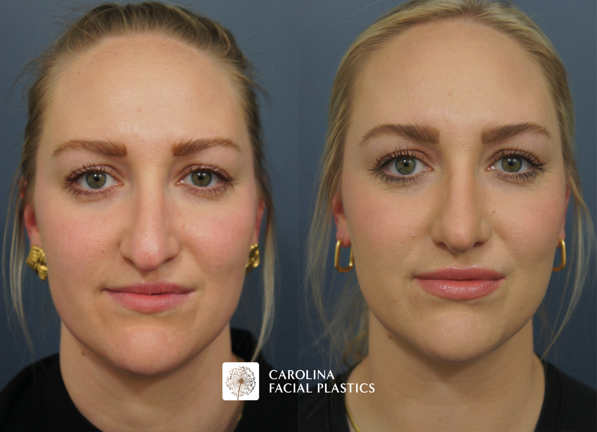 Revision Rhinoplasty & Neck Liposuction