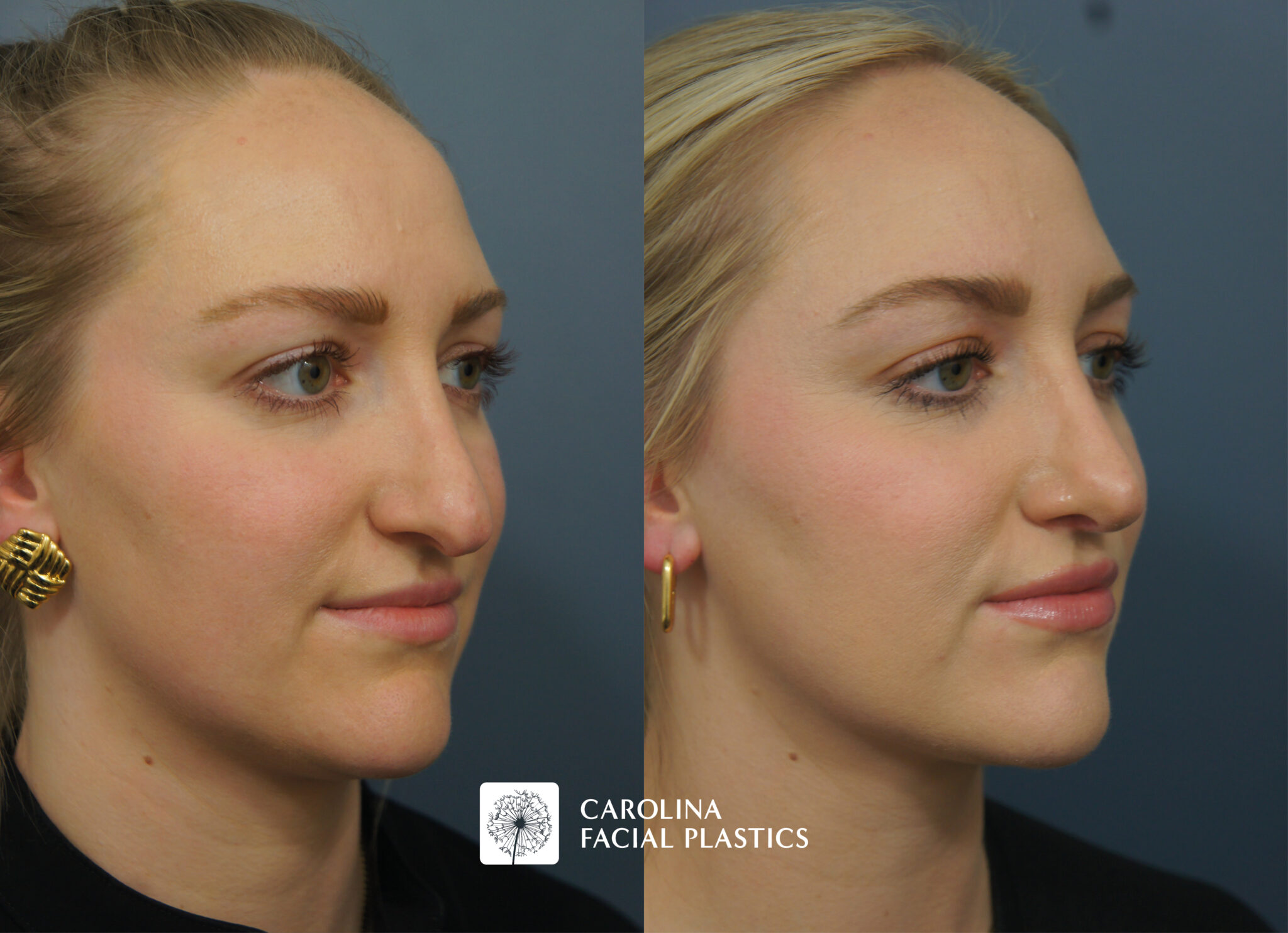 Revision Rhinoplasty & Neck Liposuction