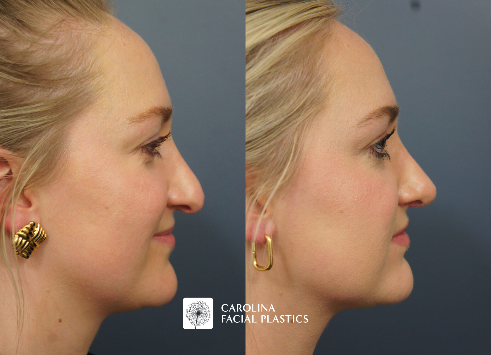 Revision Rhinoplasty & Neck Liposuction