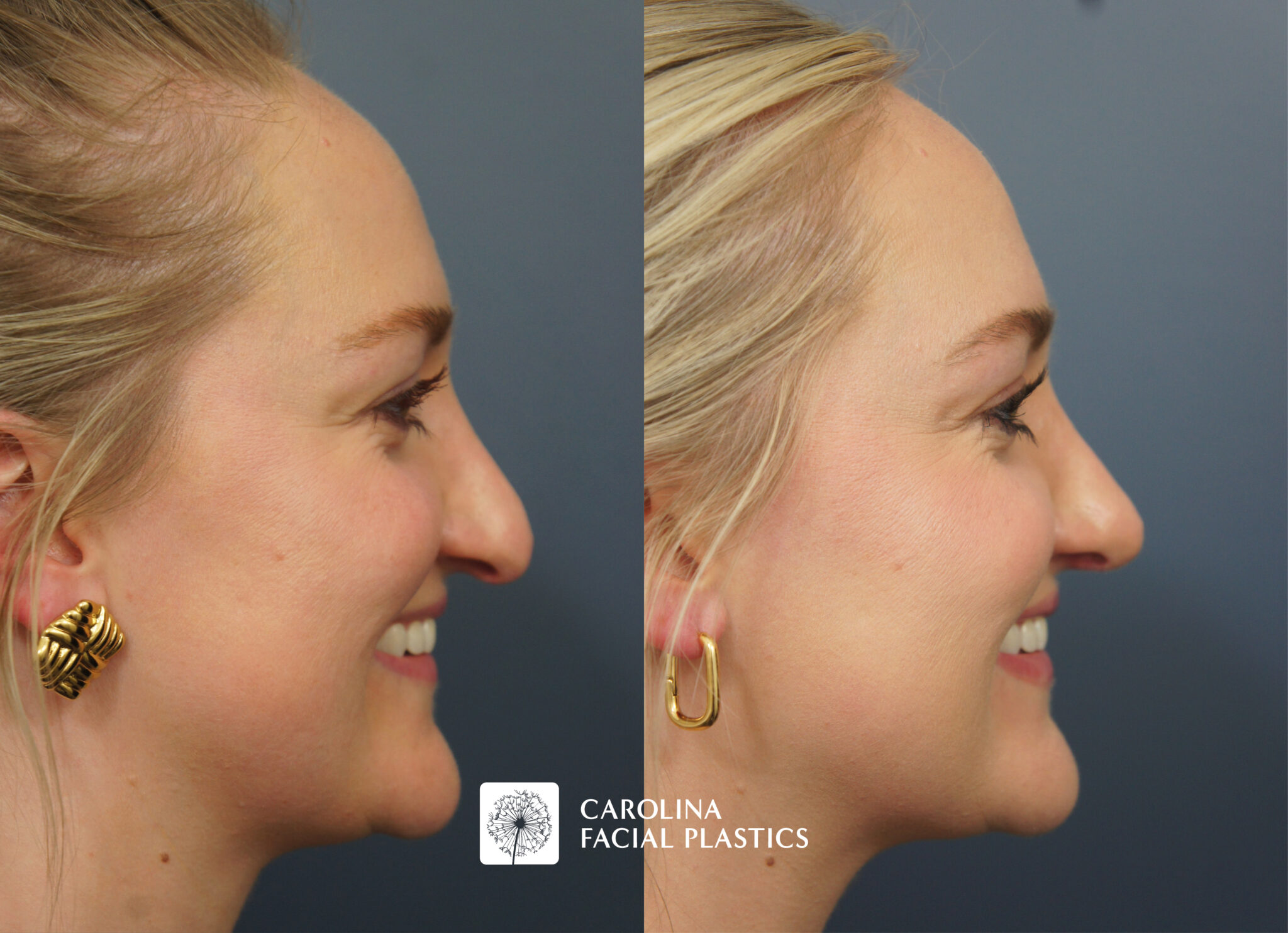 Revision Rhinoplasty & Neck Liposuction