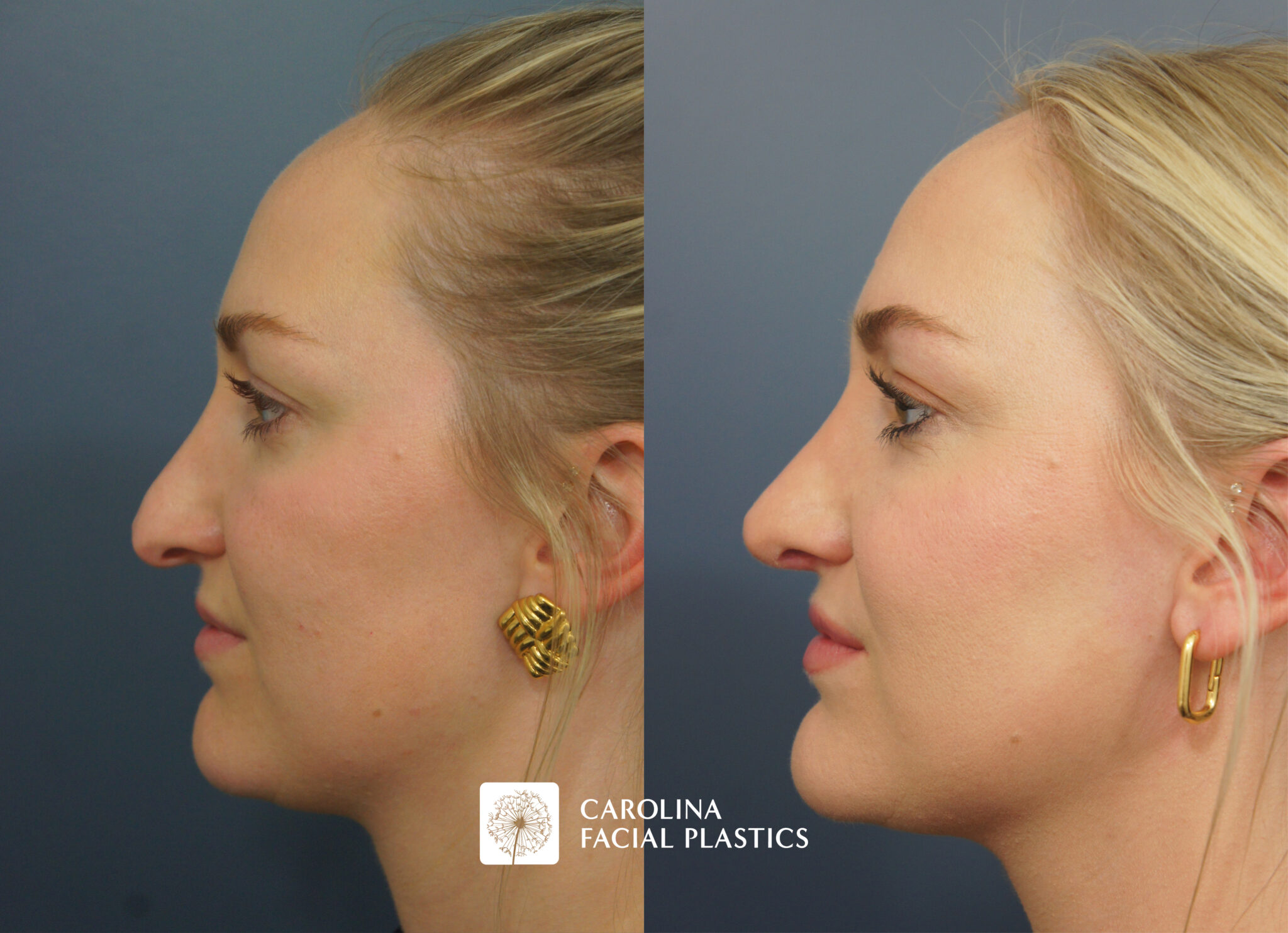 Revision Rhinoplasty & Neck Liposuction
