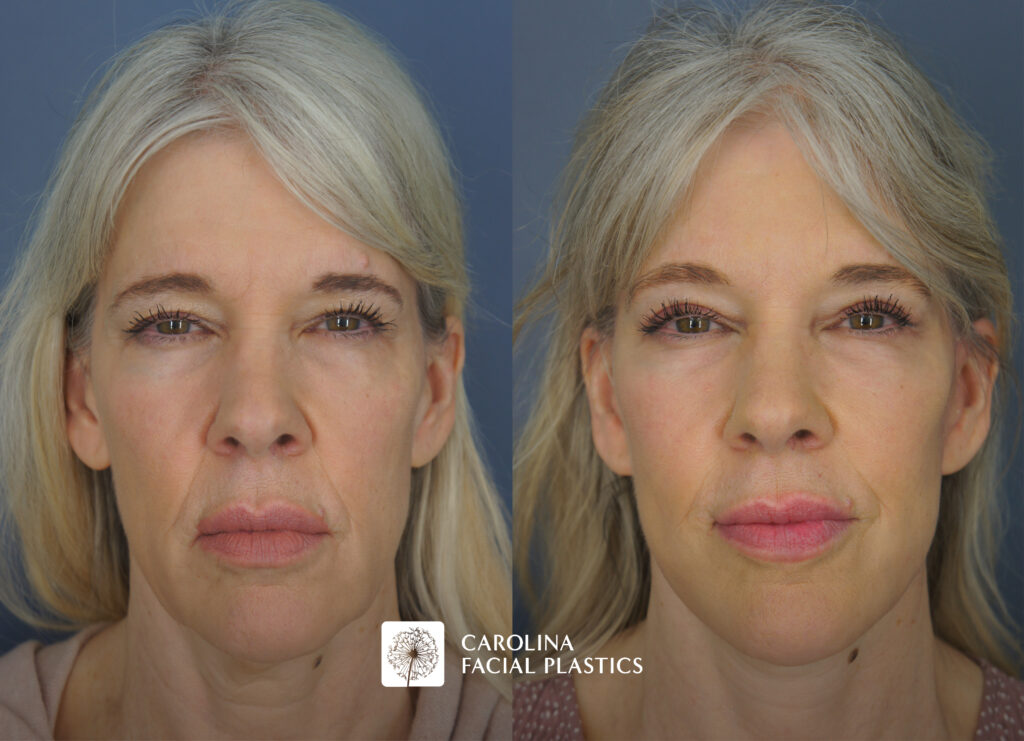 before and after brow lift and upper belph in charlotte