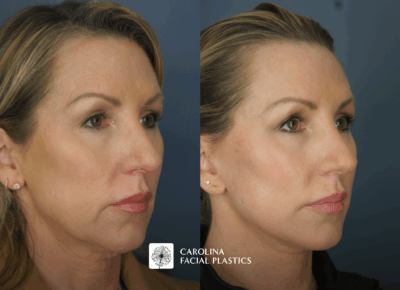 before and after mini facelift in charlotte, nc