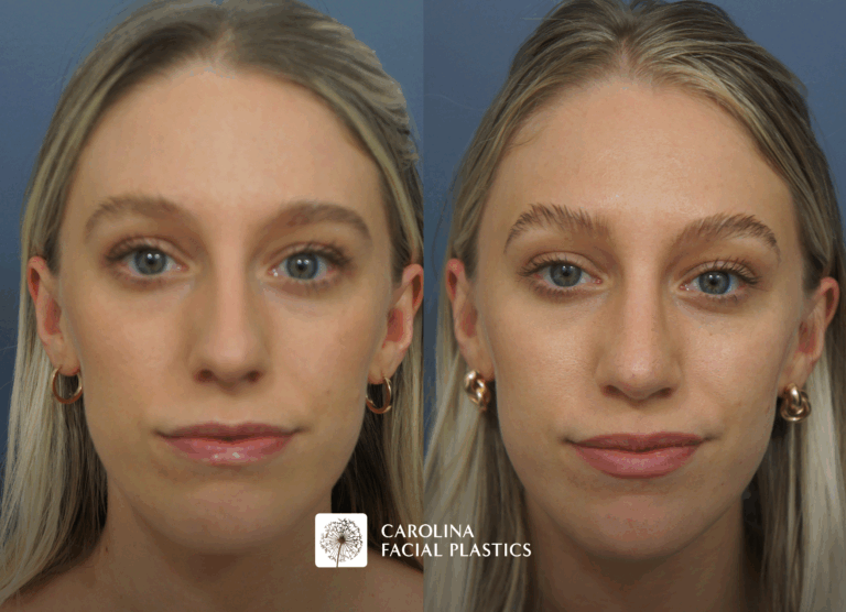 before and after septorhinoplasty