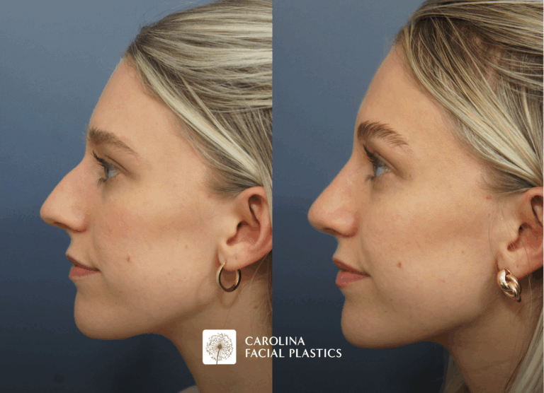 before and after septhorhinoplasty in charlotte