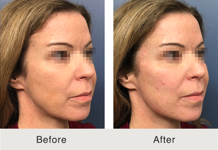 before and after jawline contouring in Charlotte