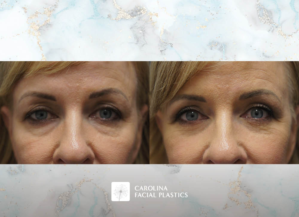 Kulbersh face lift fat grafting quad blepharoplasty chemical peel