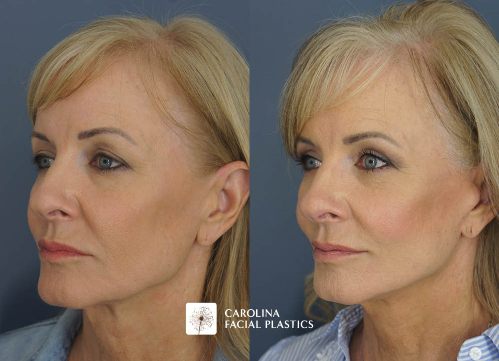 Kulbersh face lift fat grafting quad blepharoplasty chemical peel
