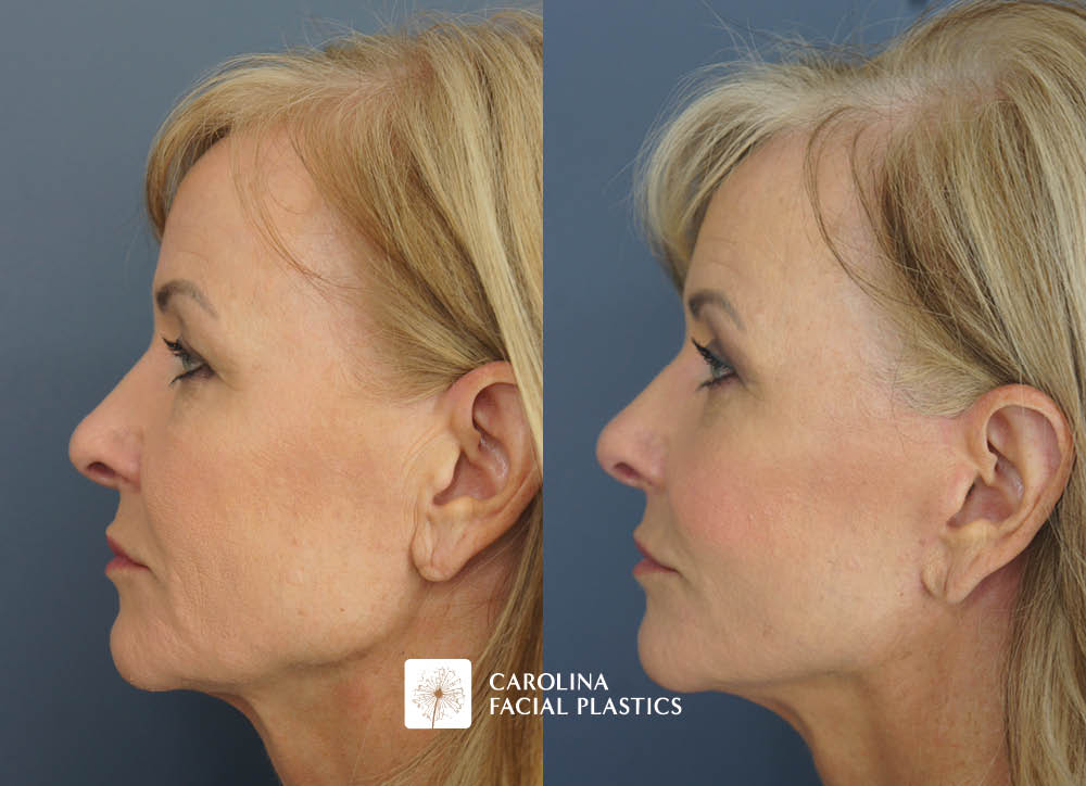 Kulbersh face lift fat grafting quad blepharoplasty chemical peel