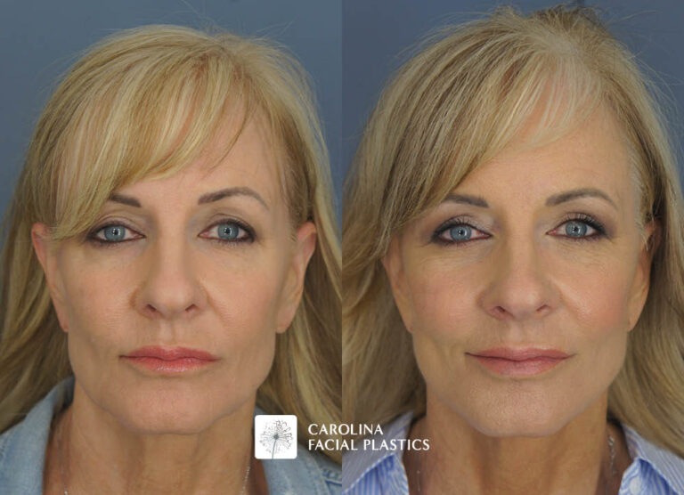 Kulbersh face lift fat grafting quad blepharoplasty chemical peel