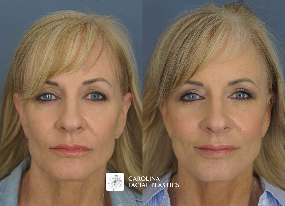 Kulbersh face lift fat grafting quad blepharoplasty chemical peel