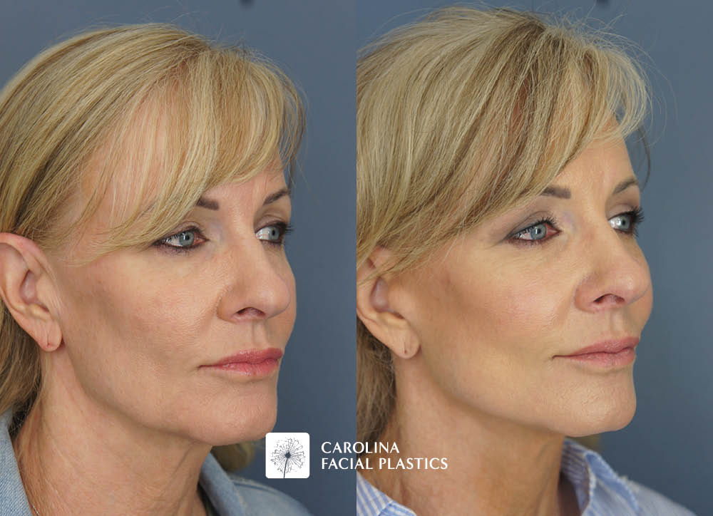 Kulbersh face lift fat grafting quad blepharoplasty chemical peel