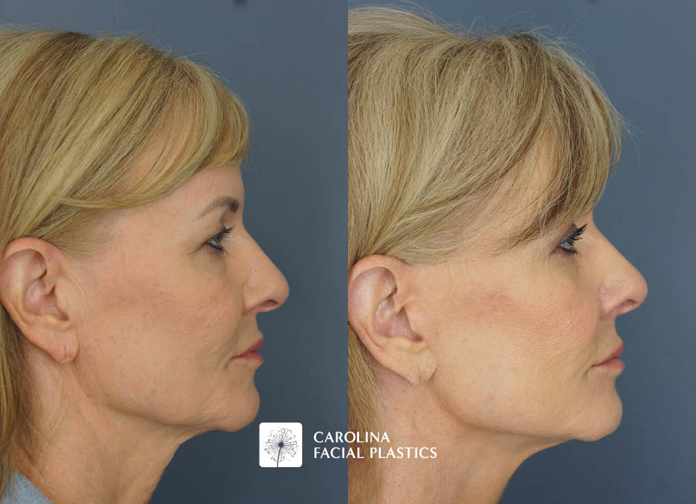 Kulbersh face lift fat grafting quad blepharoplasty chemical peel