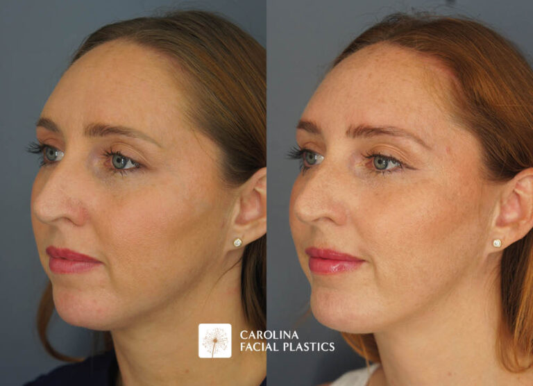 Kulbersh chin implant before and after