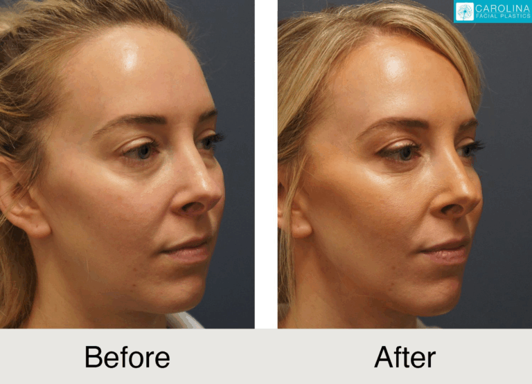 Female patient before and after eye treatment in Charlotte