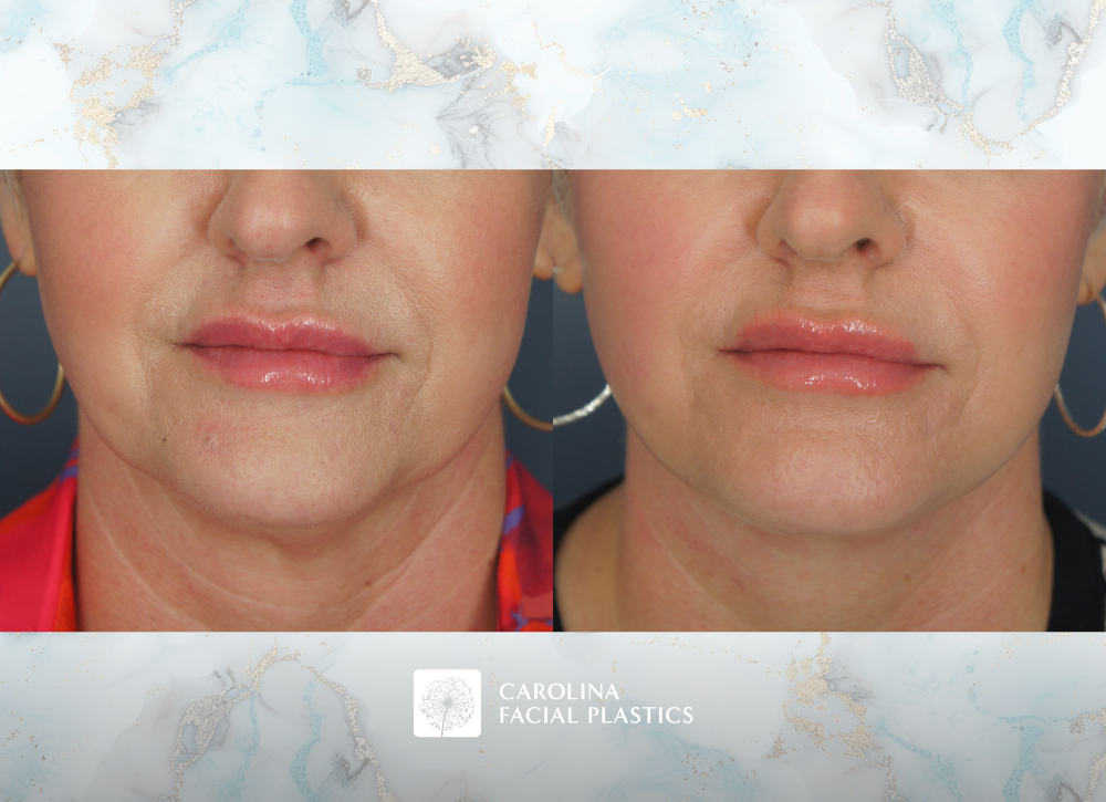 Carolina Facial Plastics Lower Face & Neck Lift with Buccal Fat Excision by Dr Kulbersh