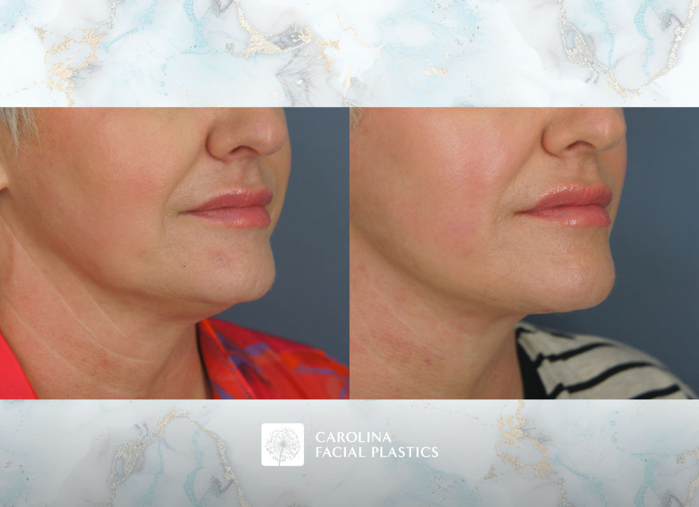 Carolina Facial Plastics Lower Face & Neck Lift with Buccal Fat Excision by Dr Kulbersh