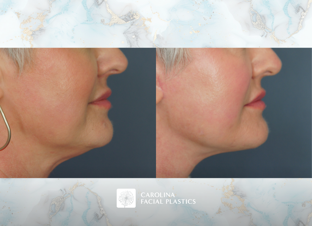 Carolina Facial Plastics Lower Face & Neck Lift with Buccal Fat Excision by Dr Kulbersh