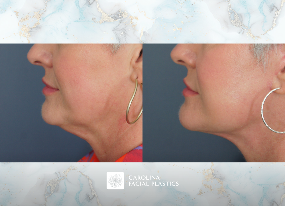 Carolina Facial Plastics Lower Face & Neck Lift with Buccal Fat Excision by Dr Kulbersh