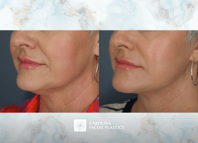 Carolina Facial Plastics Lower Face & Neck Lift with Buccal Fat Excision by Dr Kulbersh