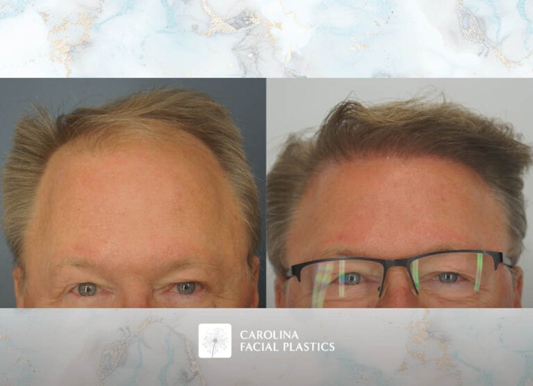 Male Hair Transplant by Heather Bryant, MPAS, PA-C