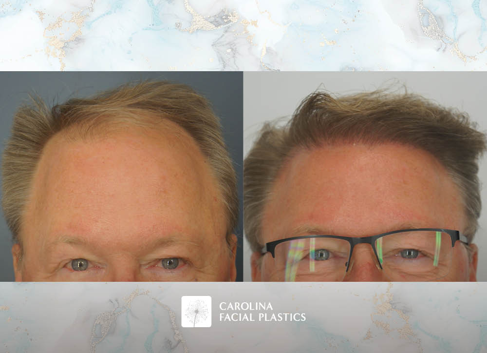Male Hair Transplant by Heather Bryant, MPAS, PA-C