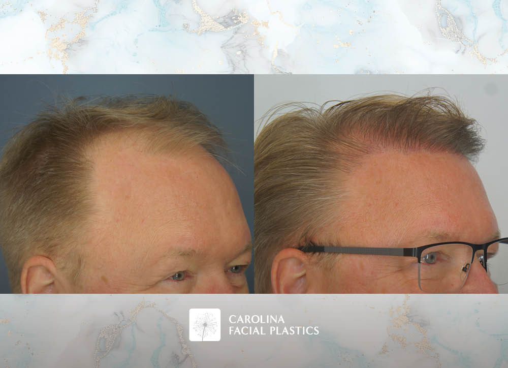 Male Hair Transplant by Heather Bryant, MPAS, PA-C
