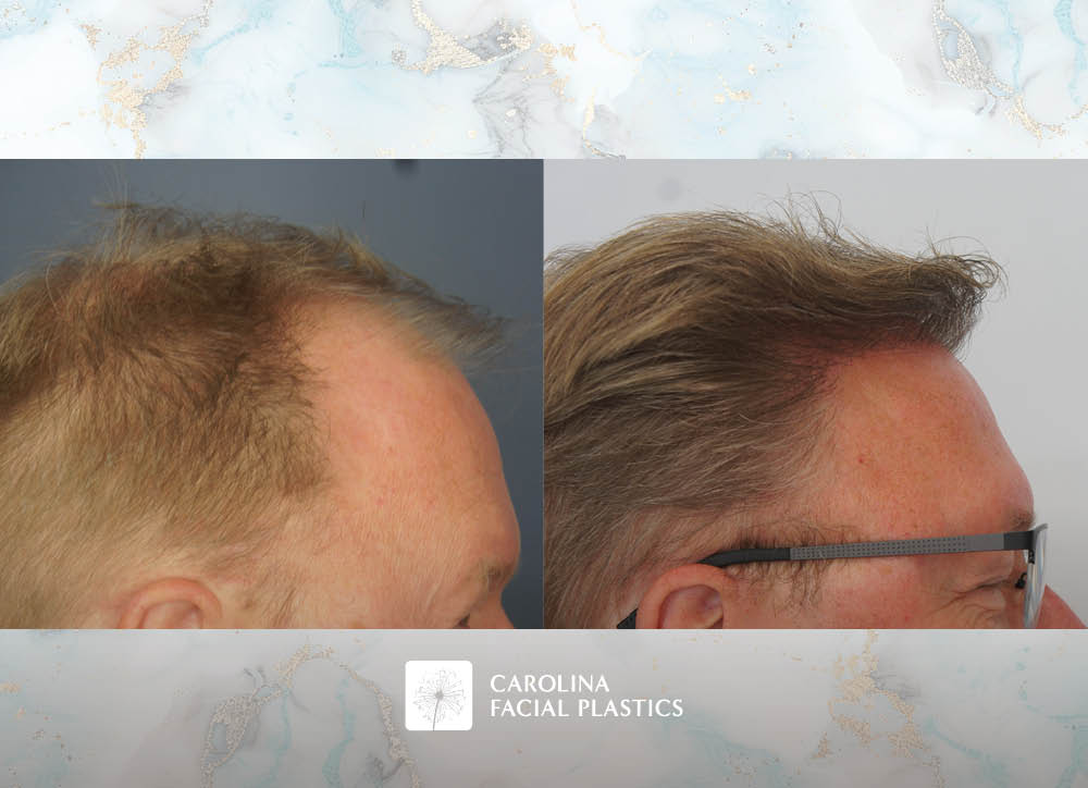 Male Hair Transplant by Heather Bryant, MPAS, PA-C