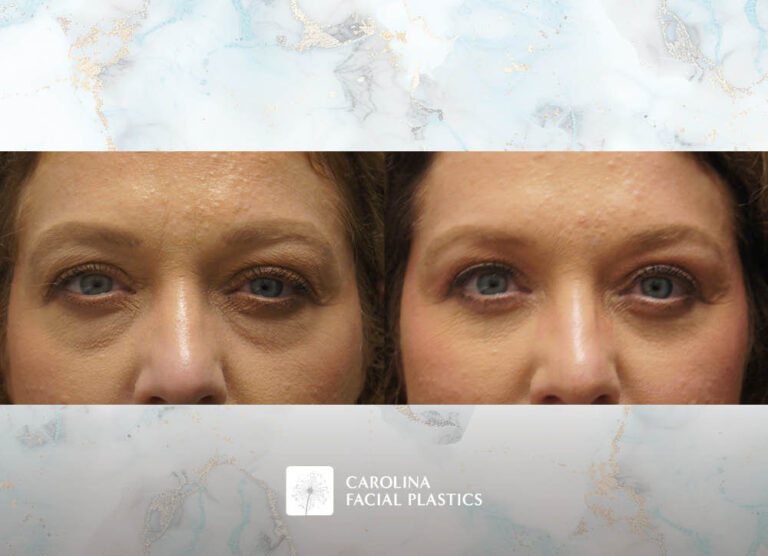 Lower Blepharoplasty with Fat Grafting by Heather Bryant, MPAS, PA-C