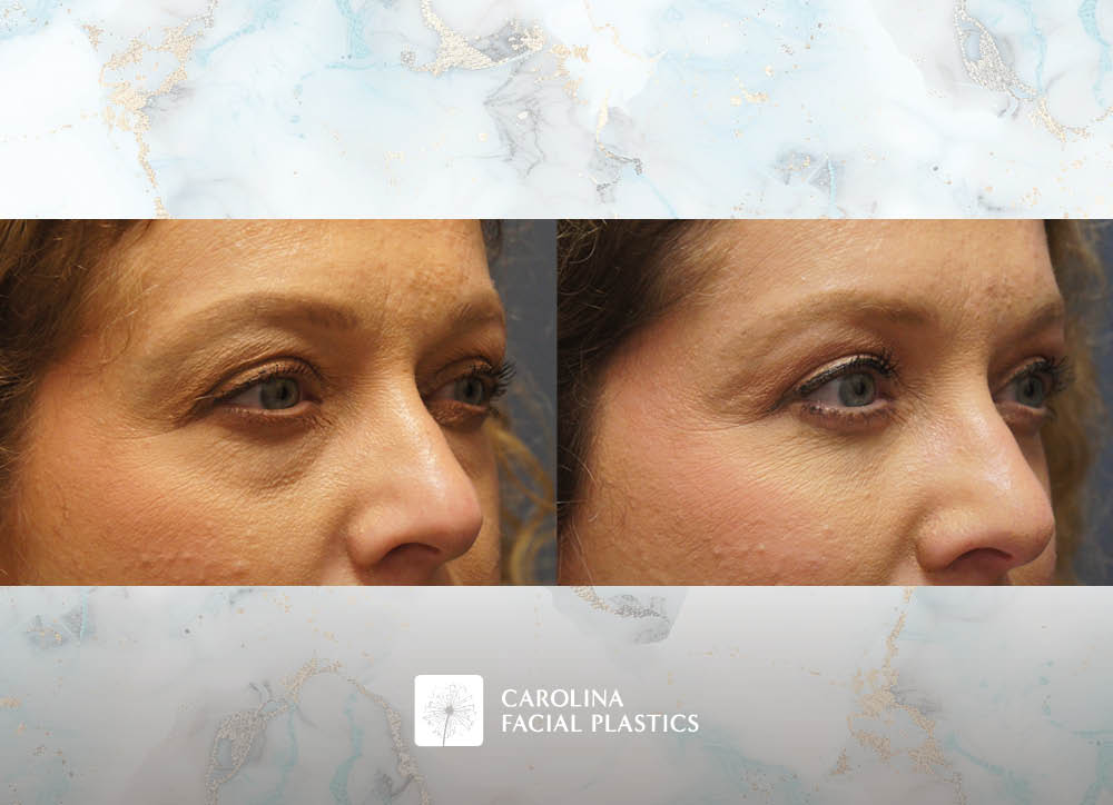 Lower Blepharoplasty with Fat Grafting by Heather Bryant, MPAS, PA-C