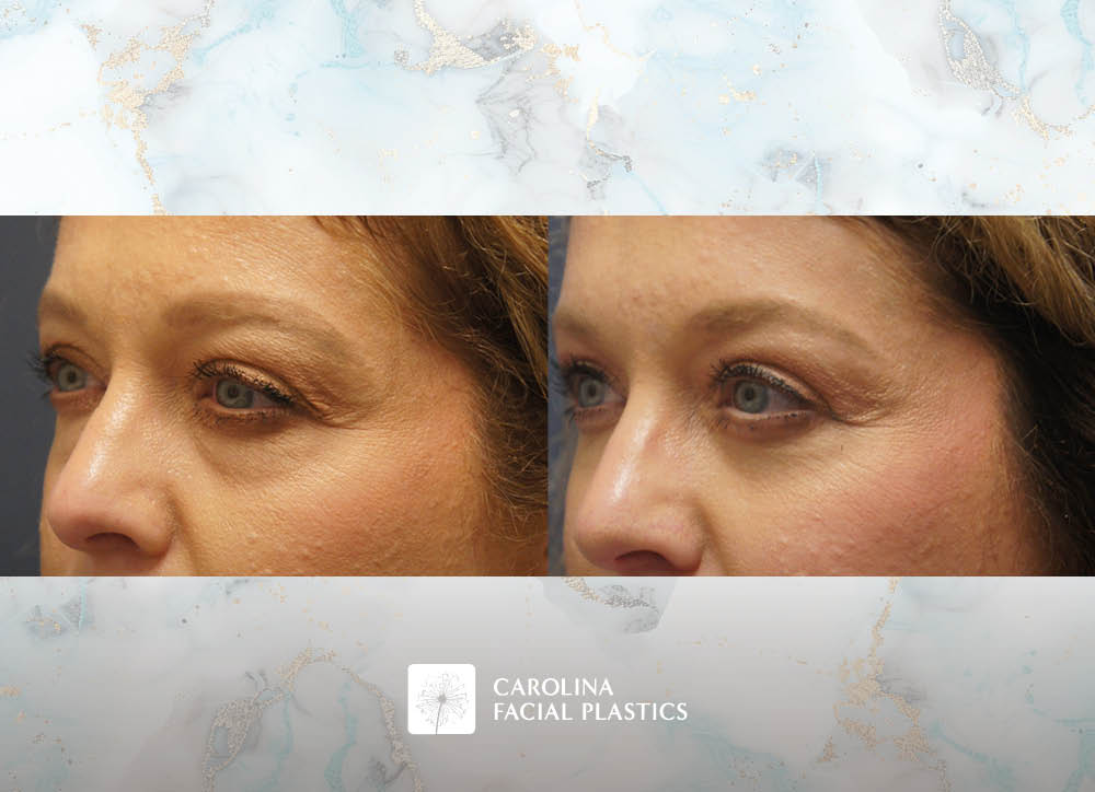Lower Blepharoplasty with Fat Grafting by Heather Bryant, MPAS, PA-C