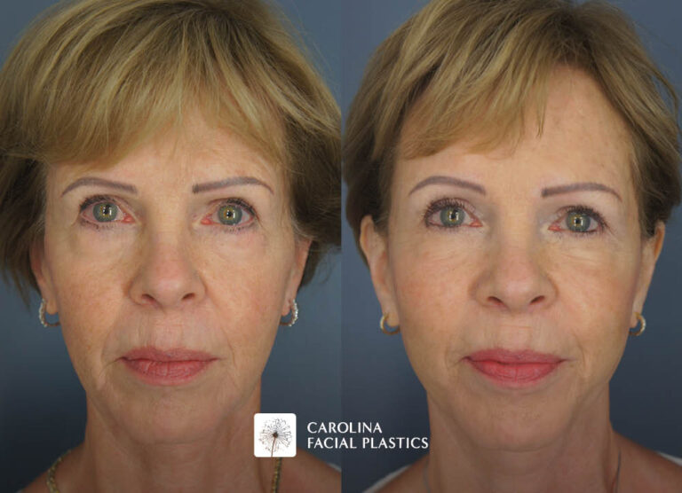 Revision Facelift, Lower Blepharoplasty, Endo Brow, and Fat Grafting by Heather Bryant, MPAS, PA-C