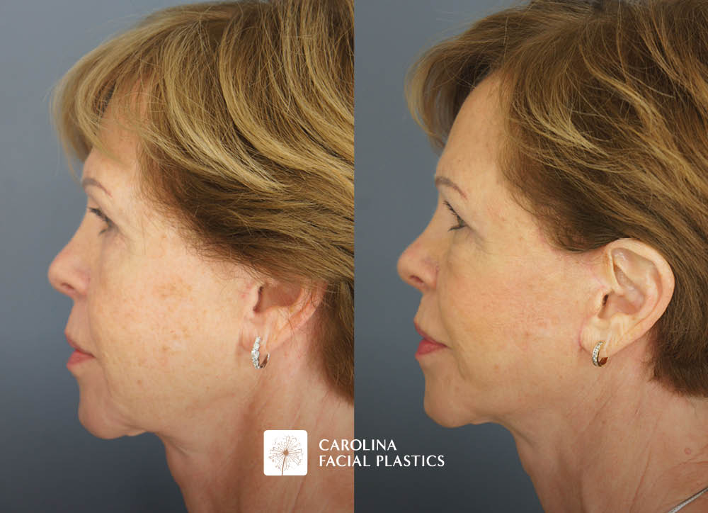 Revision Facelift, Lower Blepharoplasty, Endo Brow, and Fat Grafting by Heather Bryant, MPAS, PA-C