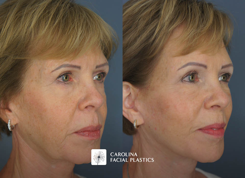 Revision Facelift, Lower Blepharoplasty, Endo Brow, and Fat Grafting by Heather Bryant, MPAS, PA-C