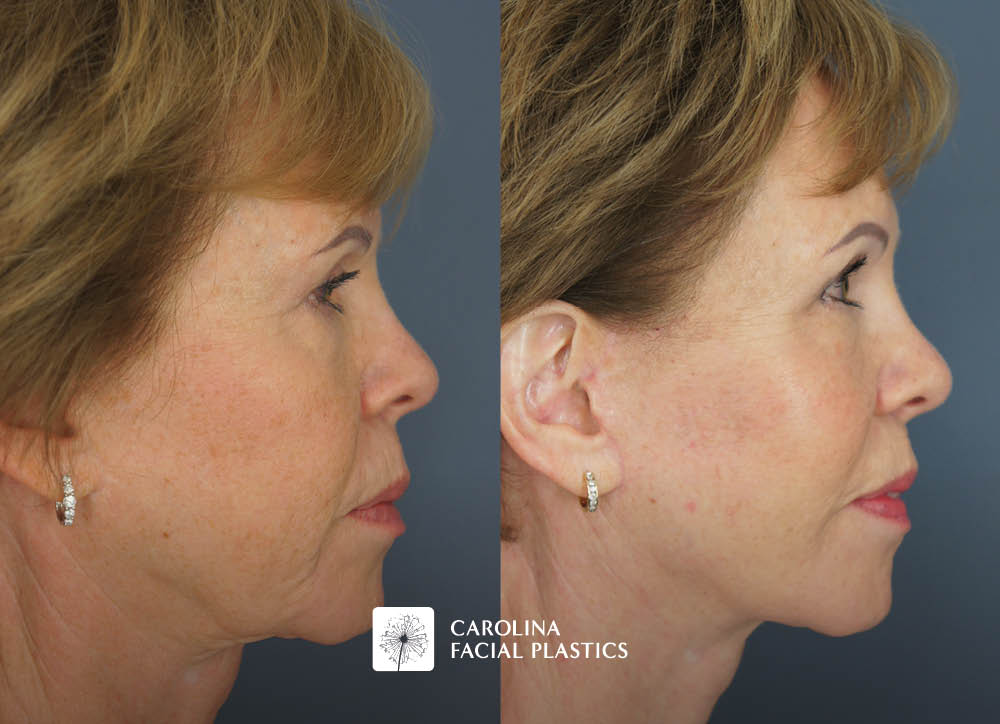 Revision Facelift, Lower Blepharoplasty, Endo Brow, and Fat Grafting by Heather Bryant, MPAS, PA-C
